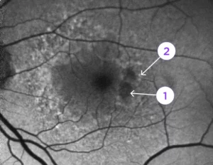 fundus autofluoresence image. caption describes the two biomarkers for GA